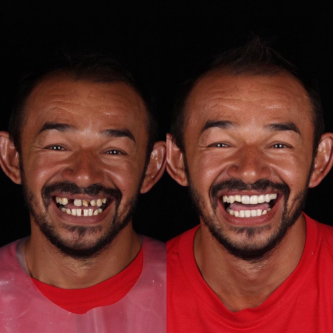 Как выглядит человек без зубов фото